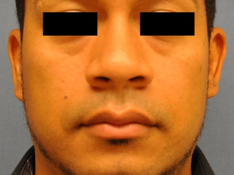 Rhinoplasty