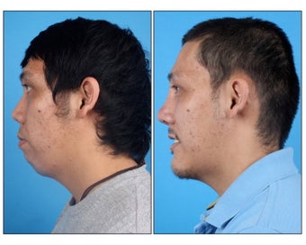 Asian Rhinoplasty and Genioplasty