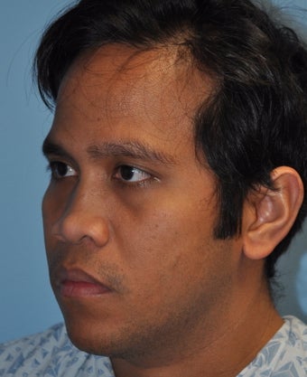 Rhinoplasty-Asian
