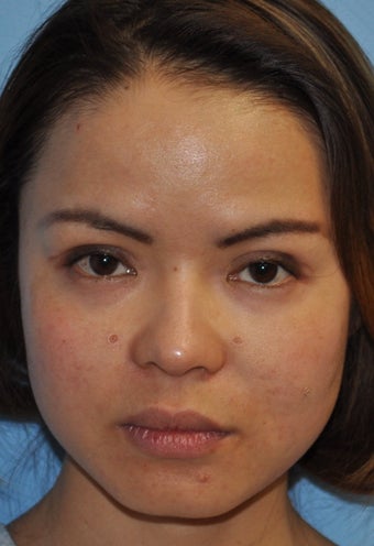Rhinoplasty-Asian