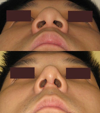Rhinoplasty