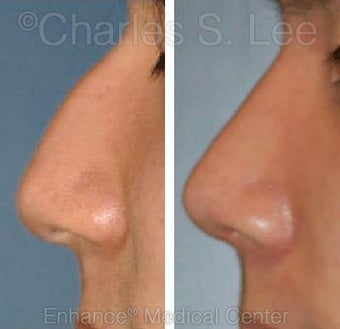 Nose
