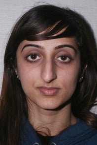 Asian Rhinoplasty