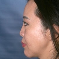 Asian Rhinoplasty