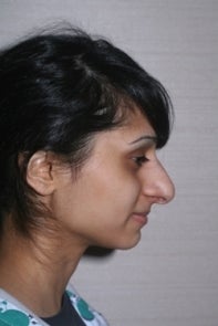 Asian Rhinoplasty