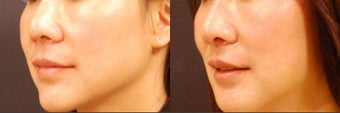 Asian rhinoplasty