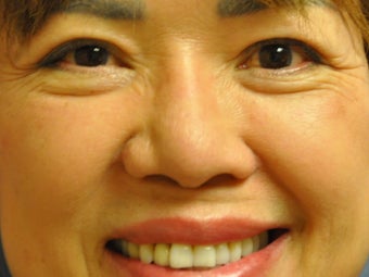 Asian Blepharoplasty