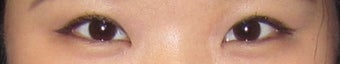 Asian Double Eyelid Surgery