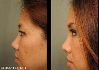 Asian Double Eyelid Surgery