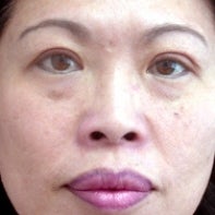 Asian Eyelid Surgery