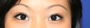 Asian Double Eyelid Surgery