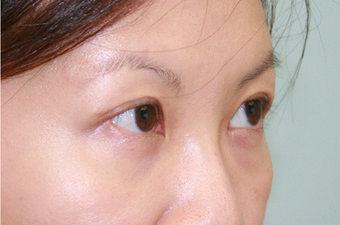 Upper blepharoplasty