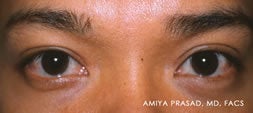 Male Asian Eyelid Surgery