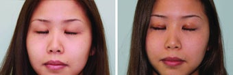 Double eyelid surgery suture