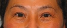 Asian Eyelid Surgery