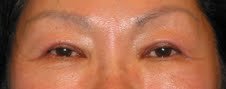 Asian Eyelid Surgery