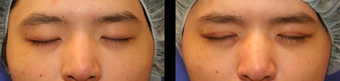 Asian eyelid surgery