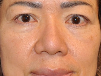 Asian Blepharoplasty