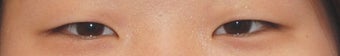 Asian Double Eyelid Surgery