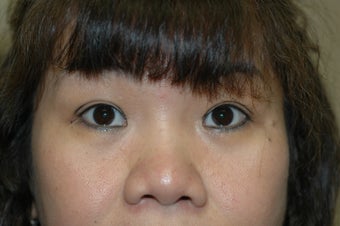 Asian eyelid surgery --  Double lid crease procedure