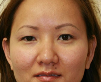 Double Eyelid procedure