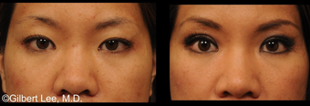 Asian Double Eyelid Surgery