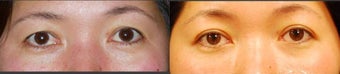 Female Double Eyelid 