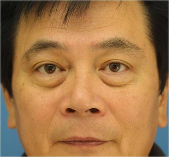 Blepharoplasty, Eyelid Surgery
