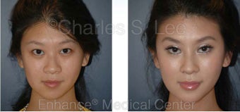 Blepharoplasty, Rhinoplasty and Chin Augmentation