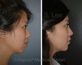 Blepharoplasty, Rhinoplasty, Chin Augmentation