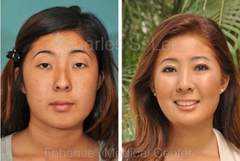 Eyelid, Nose and Chin