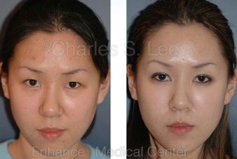 Blepharoplasty