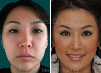 Blepharoplasty