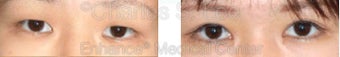Blepharoplasty