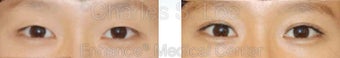 Blepharoplasty