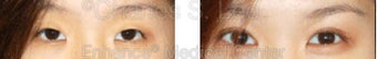 Blepharoplasty