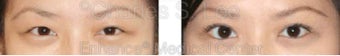 Blepharoplasty