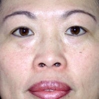 Asian Eyelid Surgery