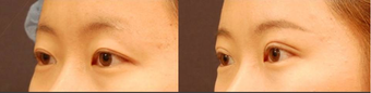 Double Eyelid Surgery Non-Incision