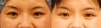 Asian Eyelid Surgery