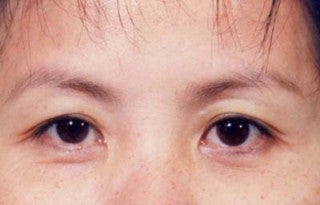 Asian eyelid surgery