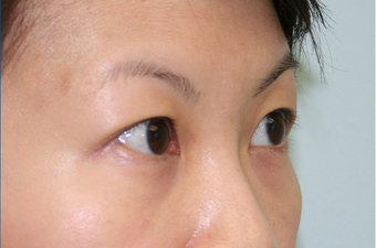 Upper blepharoplasty