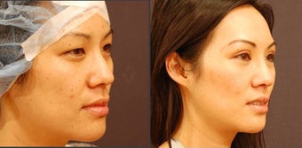 Asian Eyelid Surgery