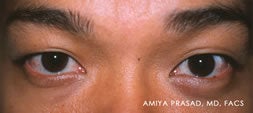 Male Asian Eyelid Surgery