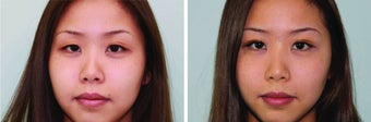 Double eyelid surgery suture