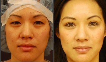 Asian Eyelid Surgery - Double Eyelid Surgery