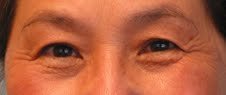 Asian Eyelid Surgery