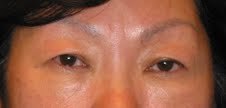 Asian Eyelid Surgery