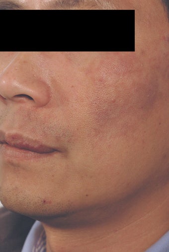 Port Wine Birthmark Removal