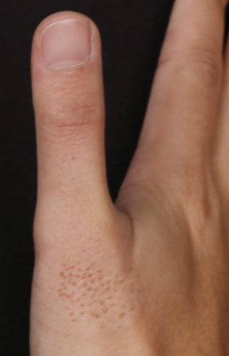 Birthmark Laser